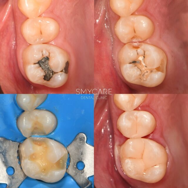 Pacient k nám přichází se starší amalgámovou výplní, pod kterou se objevil kaz, který bylo nutné odstranit a nahradit kompozitní výplní. V rámci tohoto ošetření pan doktor Abosaleh odvrtal i mezizubní kaz a tak dotáhl celý zubní kvadrant k dokonalosti. Ve čtveřici fotografií můžete vidět kompletní postup ošetření. 🦷✨

#dentalclinics #praha4 #smycare #dentalclinic #zubniklinika #zubniklinikapraha #zubar #dentalnihygiena #dentalcare #praha #dentalnihygienapraha #zubniordinace #reels #dentalclinic