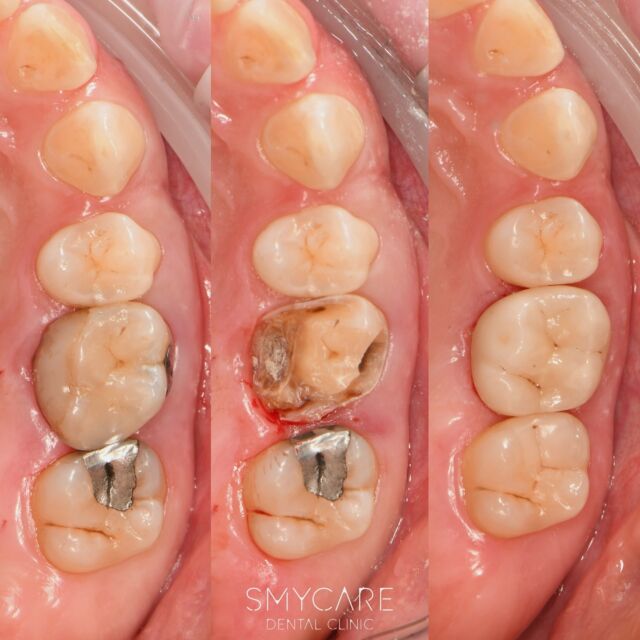Pacientka přichází s žádostí o opravu celého zubního kvadrantu. Zub 17 s amalgámovou výplní bylo nutné odvrtat starou výplň a odstranit také sekundární kaz pod vyplní, zub 16 byl již opravován v cizím zařízení. U tohoto zubu bylo nutné opět odstranit velký kaz, zub následně dostavit kompozitní výplní a laboratorně vyhotovit zubní celokeramickou korunku. U zubu 15 pan doktor pouze odstranil menší mezizubní kaz a nahradil jej tak kompozitní vyplní. 

Co říkáte na takto komplexní proměnu? 

#smycare #dentalclinic #dentist #prague #praha4 #zubniklinikapraha #zubar #lecba #prague4 #treatment