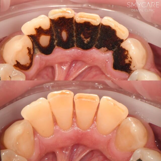 Dnešní pacient k nám přichází s velmi špatnou dentální hygienou a domácí péči, kterou spoustu let zanedbával. Takto silný zubní kámen a pigment vznikl také v souvislosti užívání nikotinových výrobků či kouření cigaret. Po odstranění takového kamene a plaku je nutné dentální hygienu navštívit velmi brzy, abychom čistý stav udrželi po co nejdelší časový úsek. 🦷✨👌🏼

#dentalnihygiena #dentalnihygienistka #dentalnihygienapraha #praha #dentist #smycare #dentalclinic #zubniklinika #zubniklinikapraha